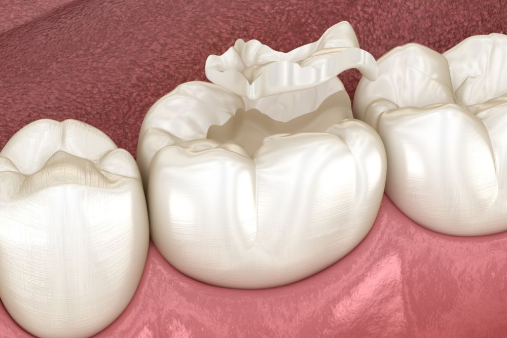 White Fillings in Brandon Florida