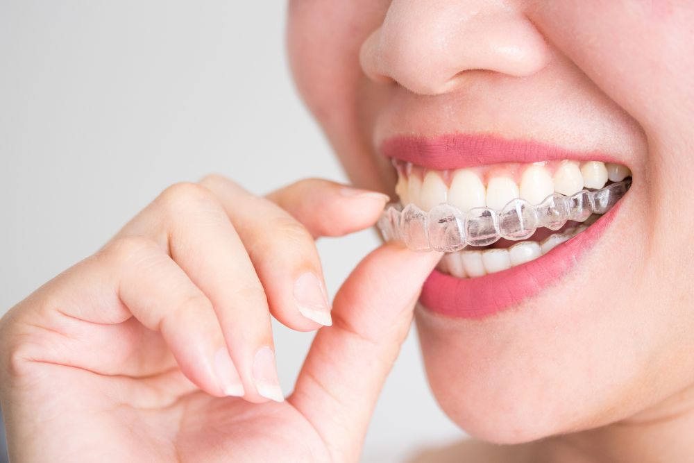 How Invisalign Works - Straightening Teeth Without Braces in Brandon, Florida