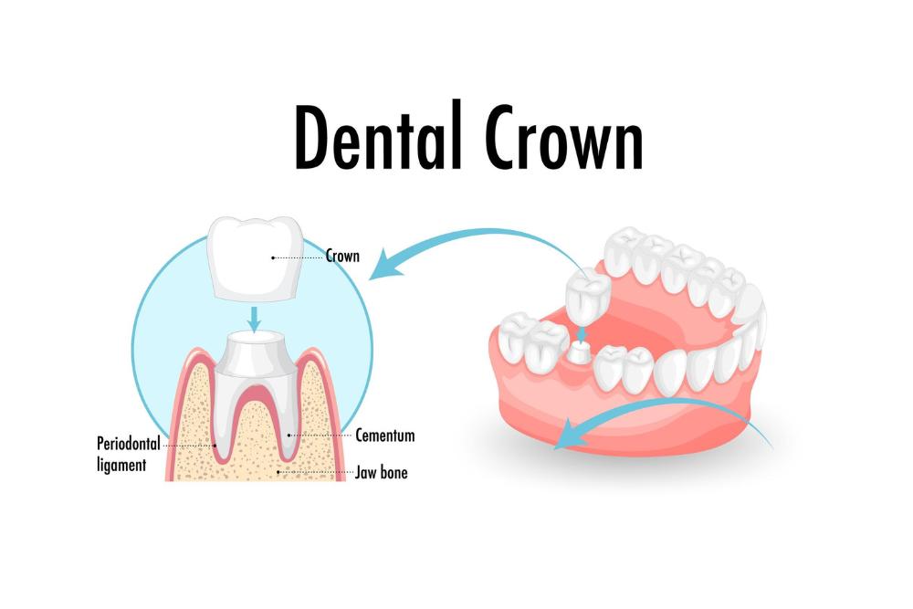 How Long Do Dental Crowns Last