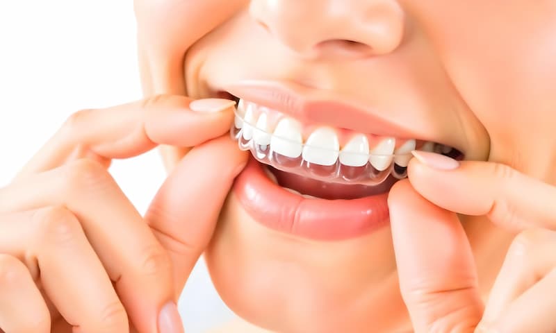The Magic of Invisalign