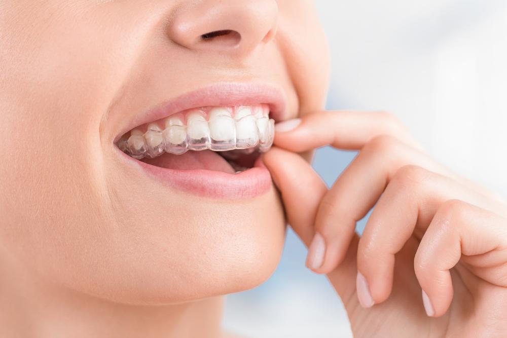 What Not to Do While Wearing Invisalign