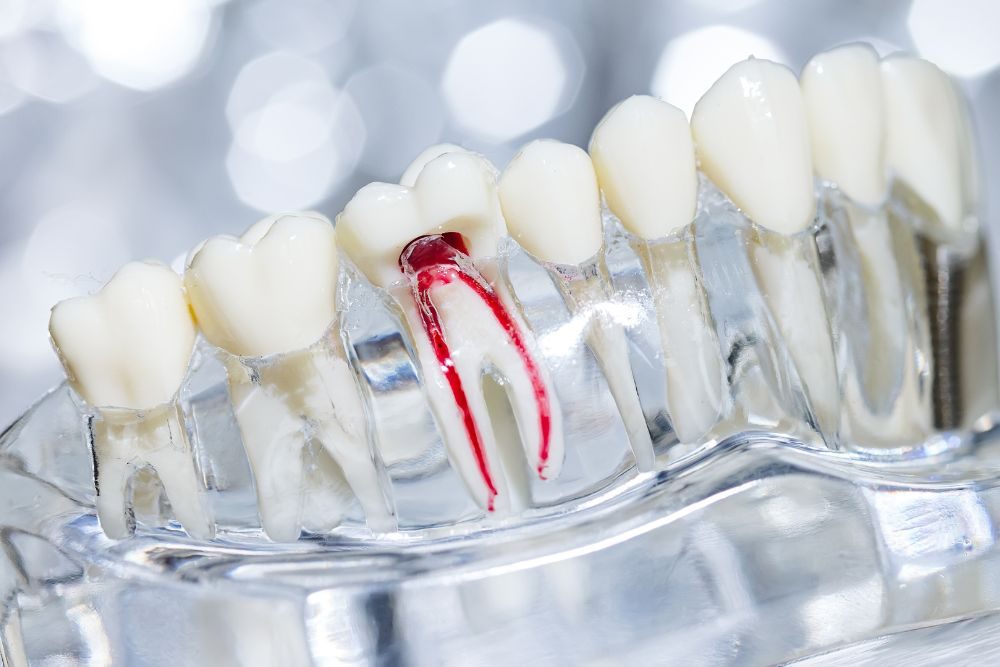 Root Canal Therapy in Brandon Florida