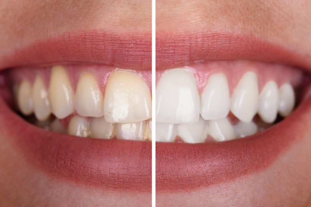 adult teeth cleaning in brandon