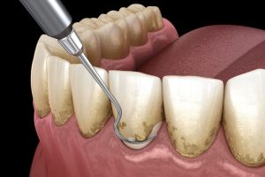 deep cleanings for teeth
