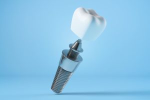 Best Dentist for Dental Implants in Brandon_ Meet Dr. Chris Karapasha