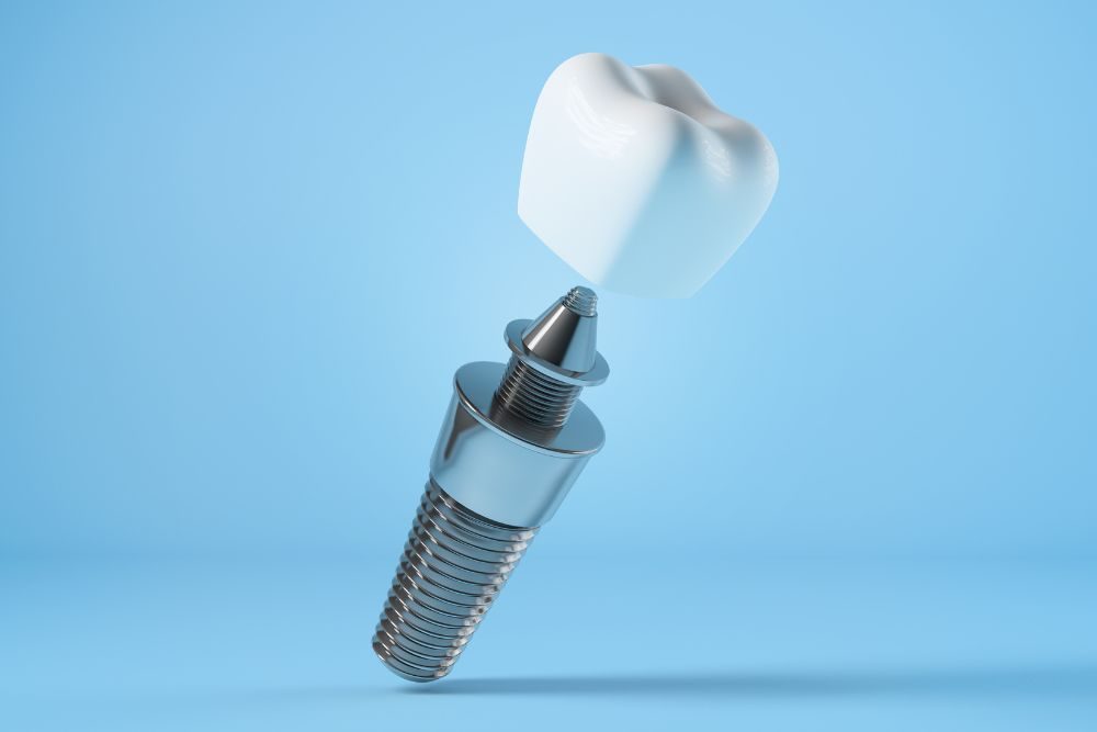 Best Dentist for Dental Implants in Brandon_ Meet Dr. Chris Karapasha