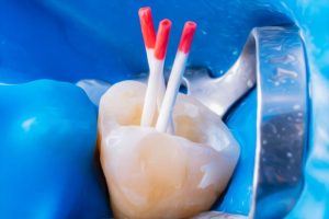 root canal therapy in brandon