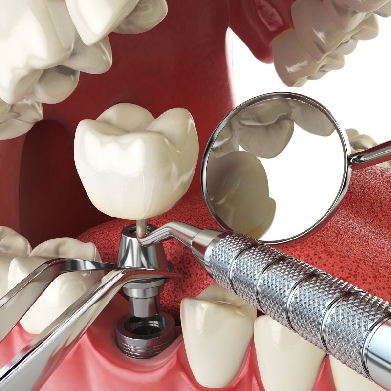 What is a Dental Crown