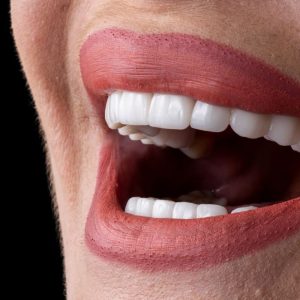 porcelain veneers