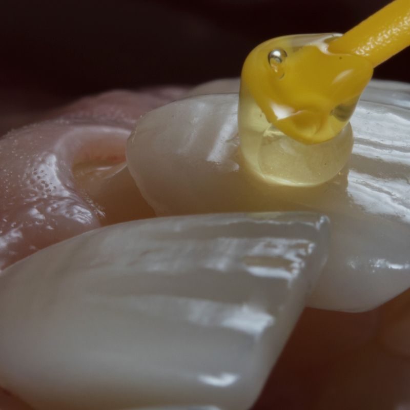 veneers for teeth in Brandon