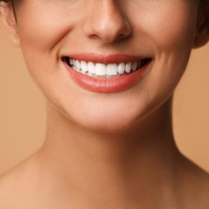 teeth after veneers