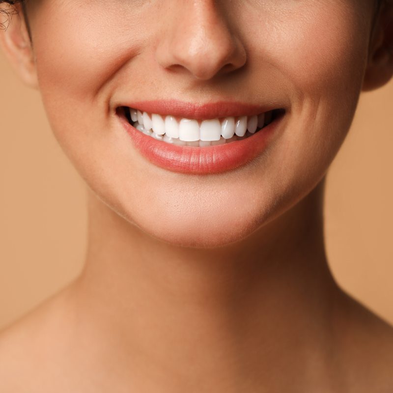 teeth after veneers