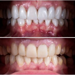 veneer dental treatment