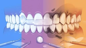 14 Consequences of Skipping Retainer Wear You Must Know